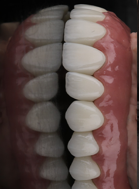 Another Upper & Lower Restoration