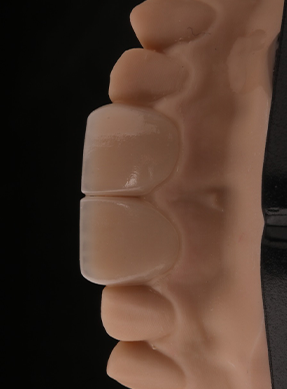 Feldspathic Veneers After Glaze